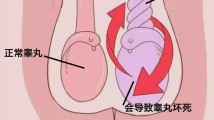女友坚持送医太关键!19岁男生睾丸扭转,黄金6小时内保住睾丸 女友坚持送医太关键!19岁男生睾丸扭转,黄金6小时内保住睾丸