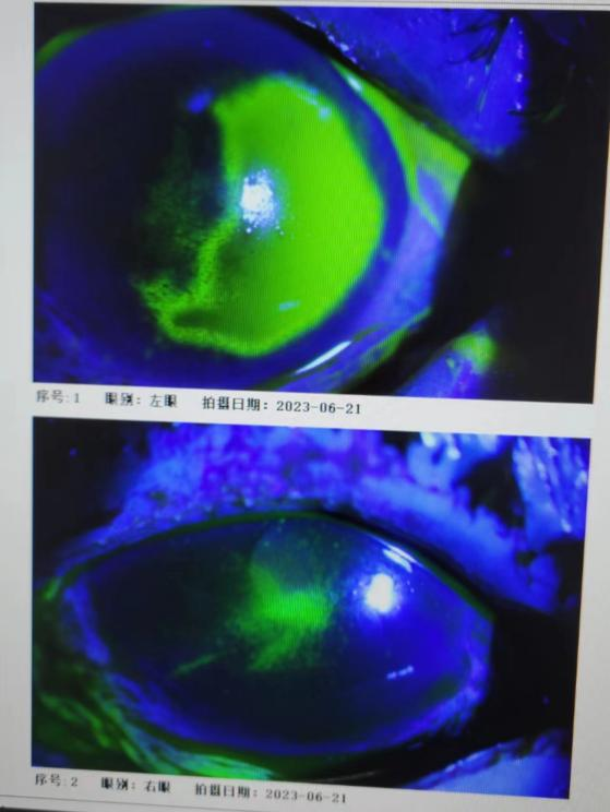 上皮损伤角膜染色，正常角膜无染色