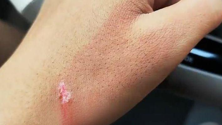 吓人！男子洗车时被高压水枪直接“割”破手！