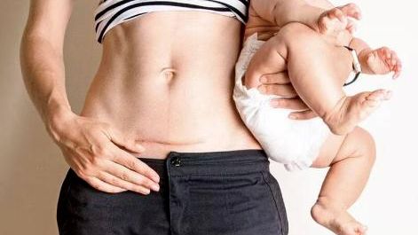 收好这份疤痕防治攻略，90%的剖宫产妈妈都能告别焦虑