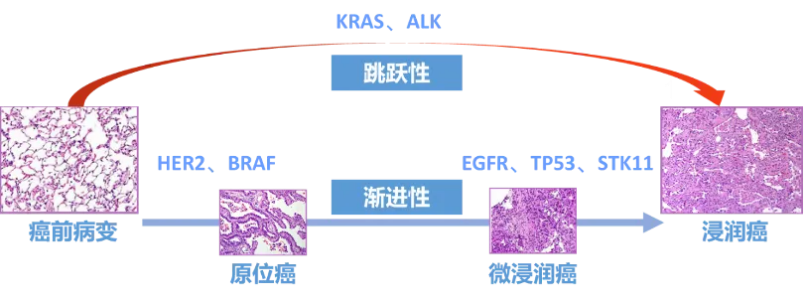 肺癌的渐进性进化和跳跃性发展