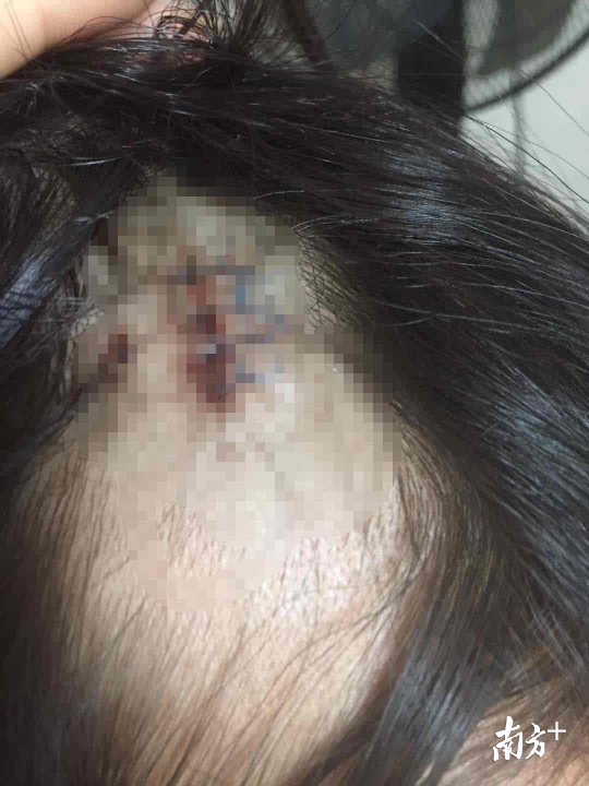 女孩头被缝针