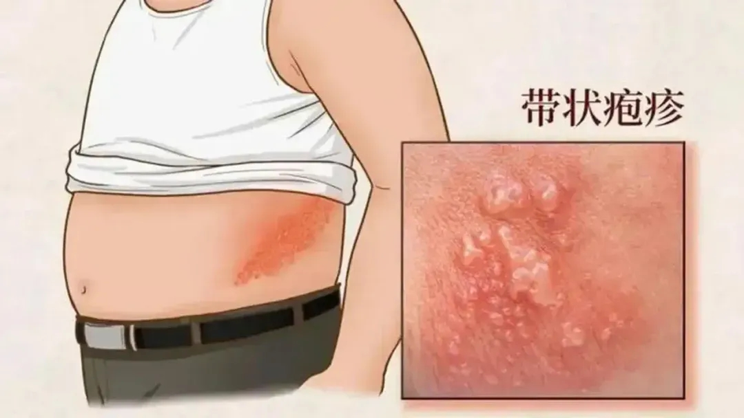 春季谨防“带状疱疹”！科学预防是关键，免疫力提升不可少
