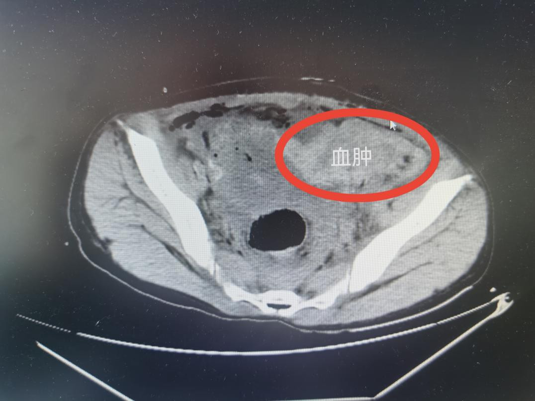 保命也要保子宫一场跨越3000多公里的紧急云救援