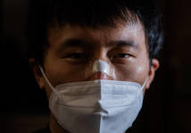 战疫影像｜口罩戴太久，医生鼻子被压伤