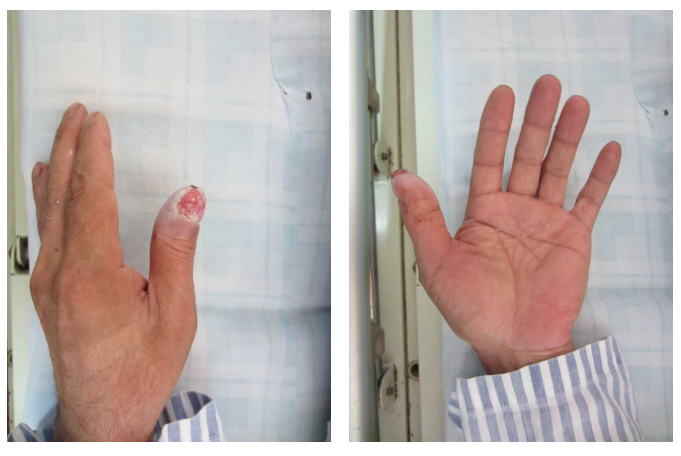 医院过往收治的患者,烧伤面积小未及时就医,氢氟酸不断渗透导致伤口很深