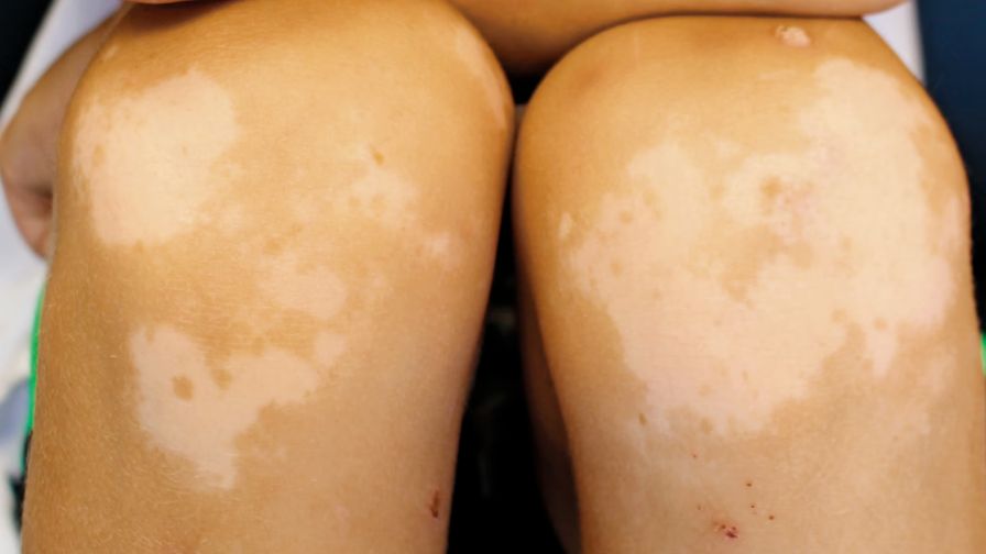 孩子皮肤上长小白斑，是白癜风吗？这几种信号不要轻易忽视