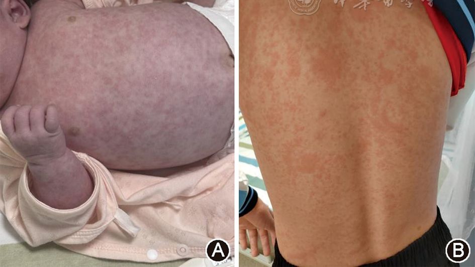 国内首部《儿童基孔肯雅热诊治专家建议（2025）》正式刊发