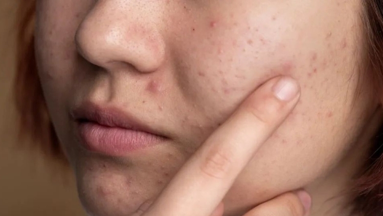 首款“治痘疫苗”进入临床，久治不愈的痘痘有望改善？