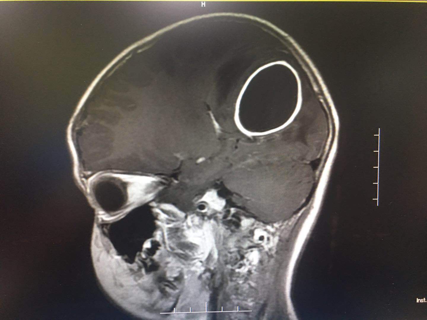 患儿影像图片，脑内脓肿清晰可见。
