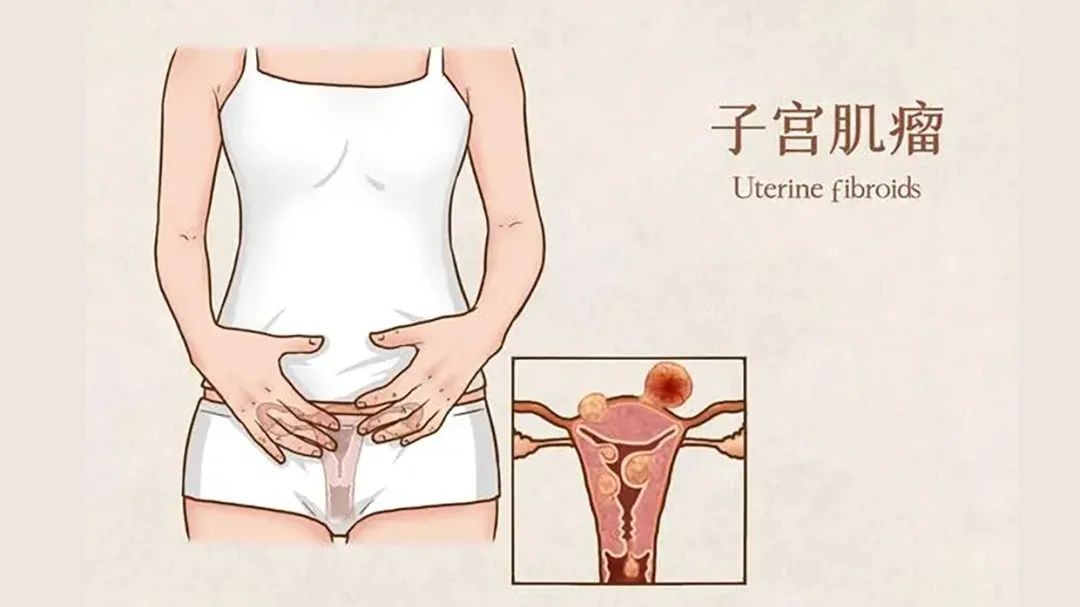 揭秘 | 女性为什么会得子宫肌瘤？一定要手术吗？