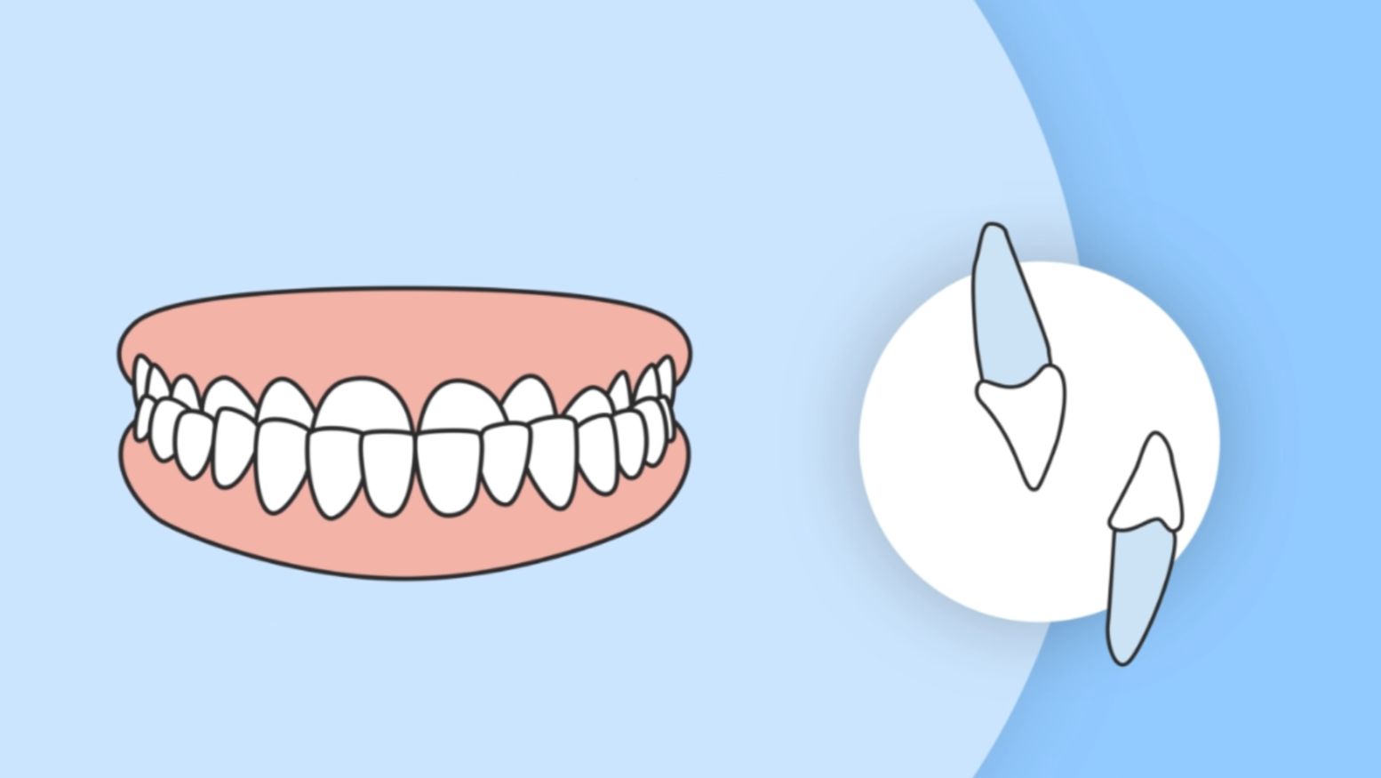 别以为换牙后“地包天”能自然好！抓住这3个干预黄金期，孩子少受罪