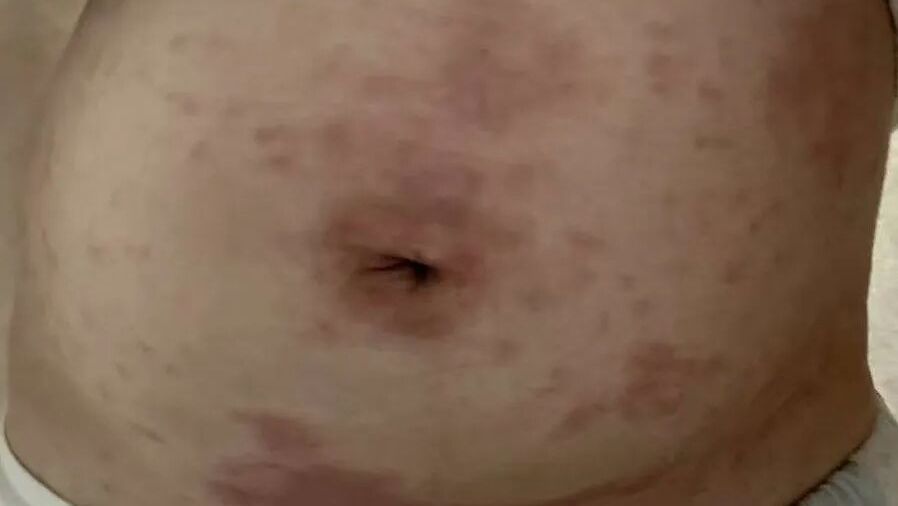 痒痒痒……孕期肚皮起红疹，出现这些情况请及时就医！