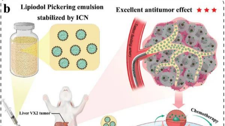 Guangdong-developed innovative emulsion offers new hope for liver cancer patients