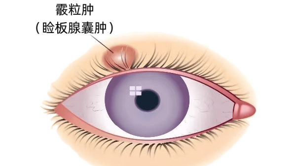 眼睛揉出血和肉球急坏五旬阿姨 专家揭示霰粒肿防治要点