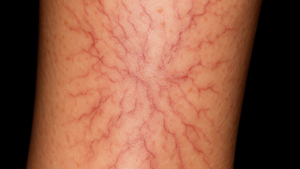 别让“小蚯蚓”变成“老树皮”，这些腿部的信号，千万别轻易忽视！