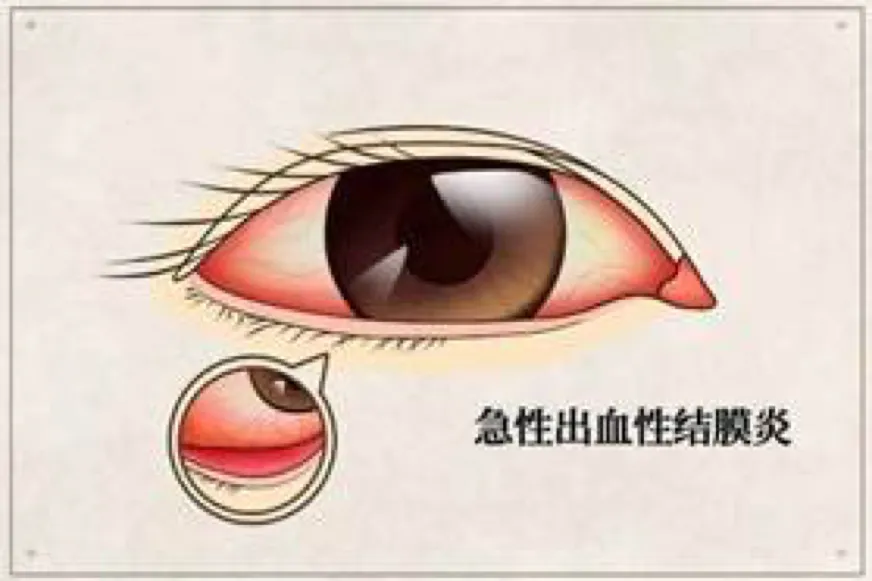 暑期水上项目玩乐，预防“红眼病”要牢记！