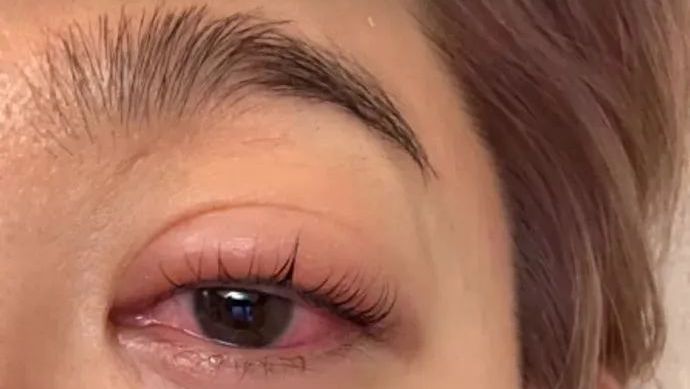 突然爆炸！女演员自曝：眼球差点炸破......